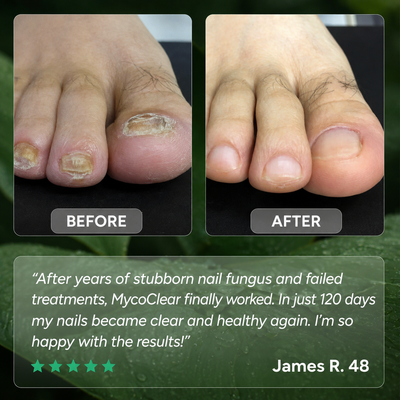 Nail Fungus Treatment Gel